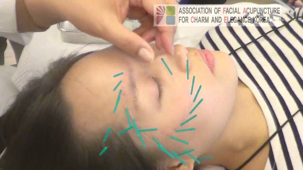 acupuncture faciale oeil