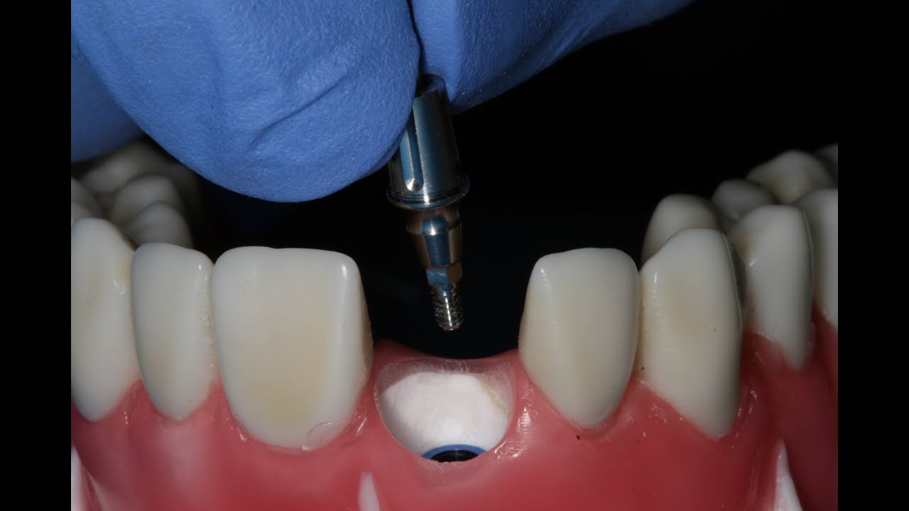 Implante Neodent helix GM - Hands on e-Symposium 27/04/21