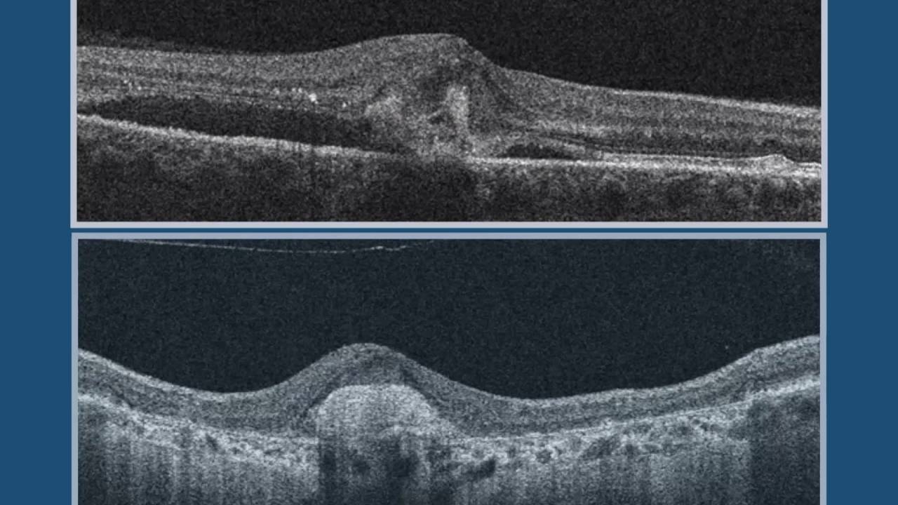 Active Choroidal Neovascularization (CNV) vs. Inactive CNV and/or Scar