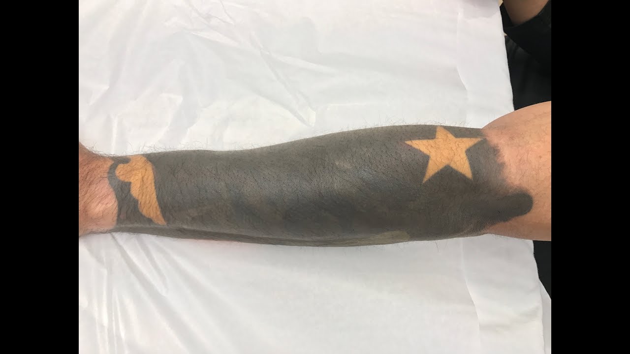 Laser Tattoo Removal - Removing Half Sleeve Tattoo - Newhope Laser Skin Care - Orange County