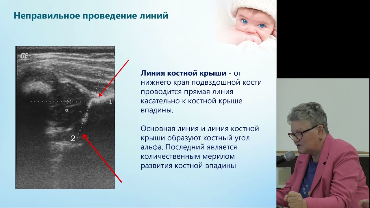 Помилки діагностики УЗД дисплазії тазостегнових суглобів