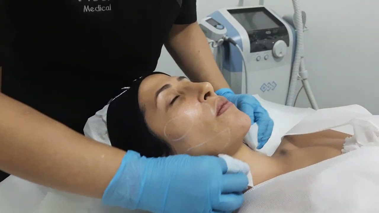 Exilis ultra 360 | Reducción de medidas | tratamiento antienvejecimiento | Vitti medical