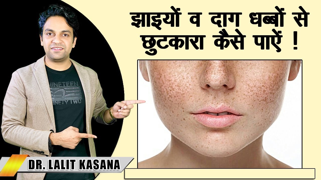 झाइयों व दाग धब्बों से छुटकारा कैसे पाएँ | डॉ० ललित कसाना | 2020