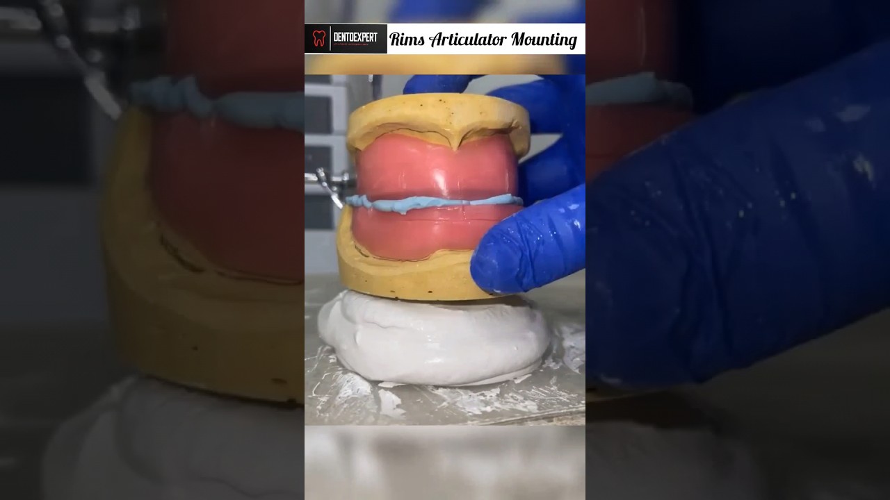 Mounting of Wax Rims on Articulator | Rims Mounting Procedure #shorts #dentist #viral