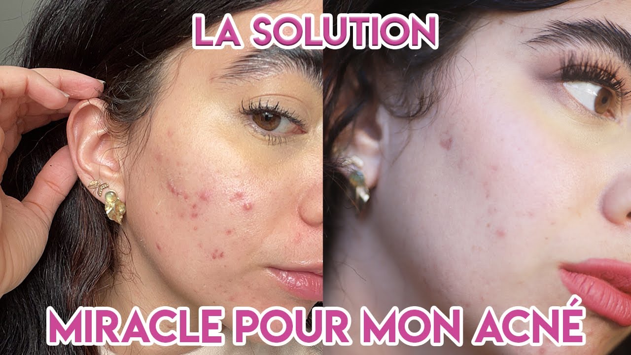 1 MOIS POUR SOIGNER MON ACNÉ AVEC LA B.....