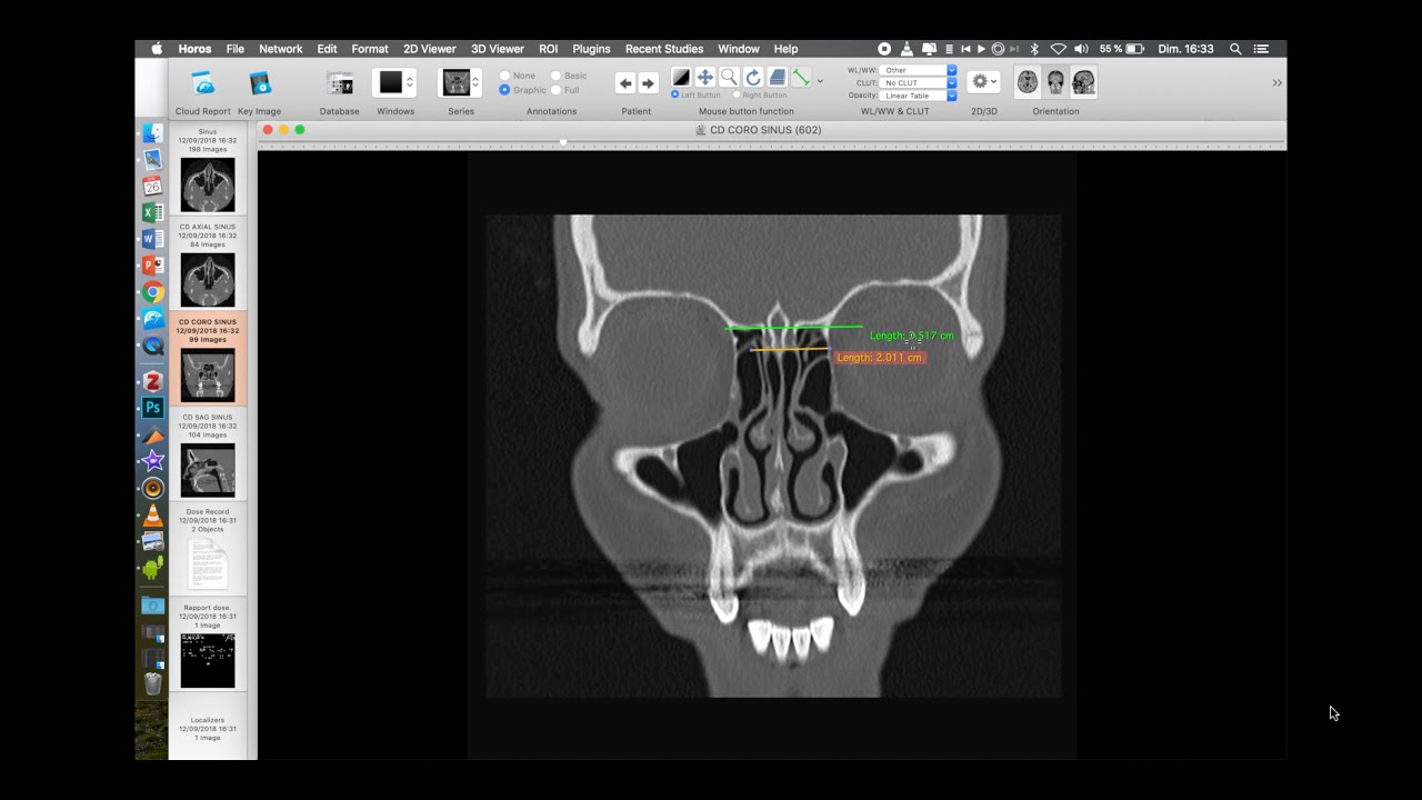 analyse du scanner avant une chirurgie endonasale