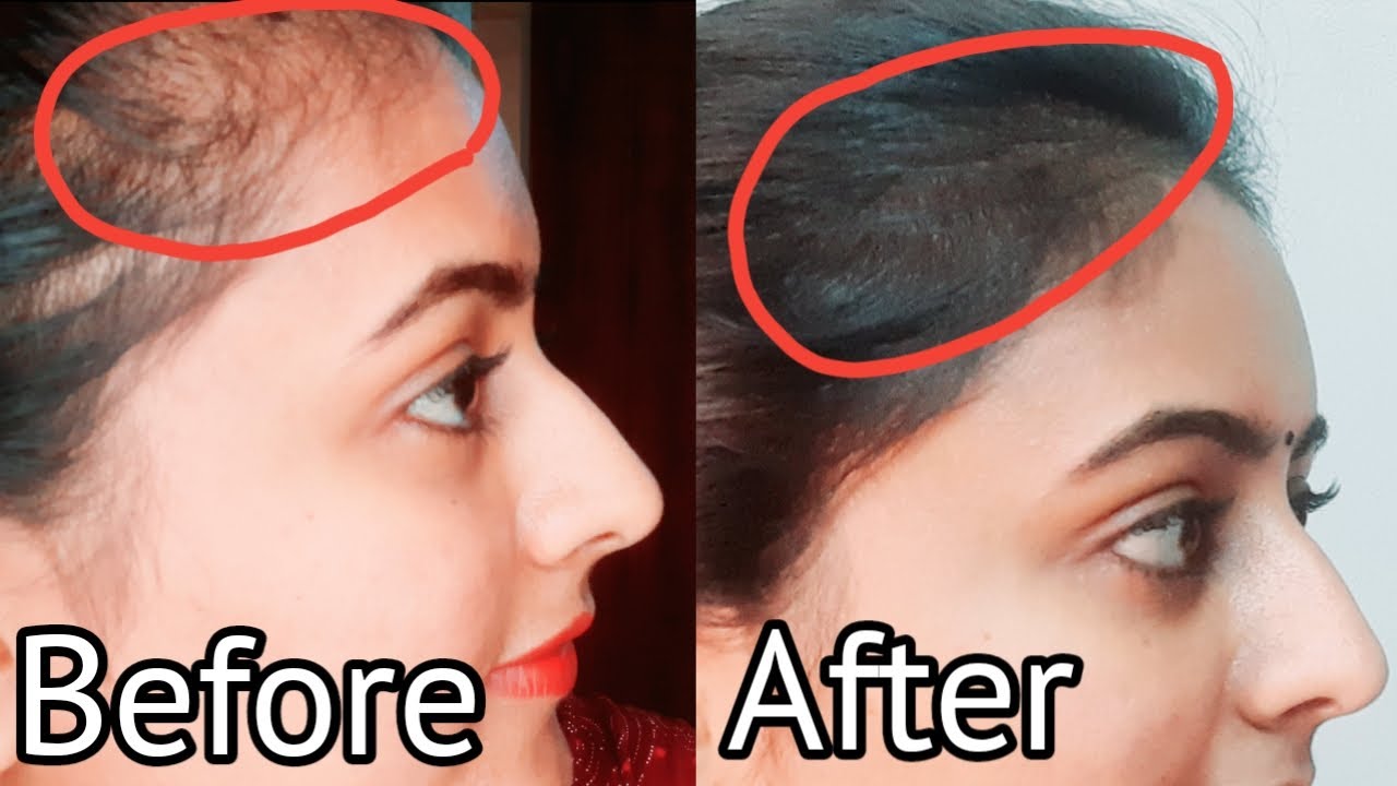 How to Stop Hair Fall || Hair REGROWTH|| 100% Natural PROVEN Method.(English Subtitles)
