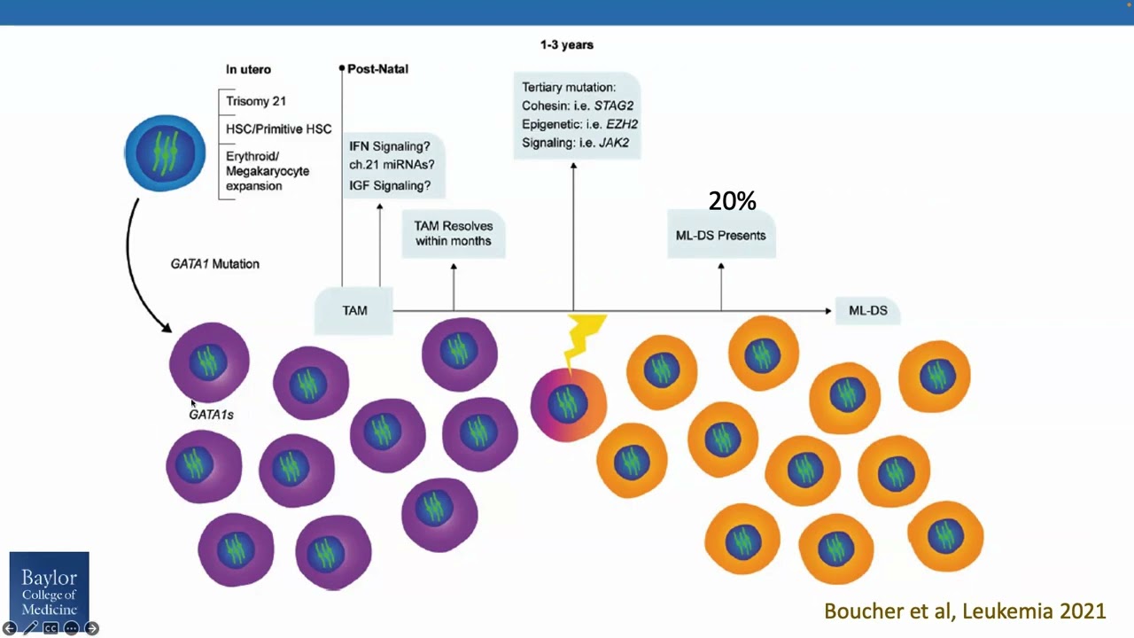 Leukemia in Children with Down syndrome: Current insights into risk factors and treatment