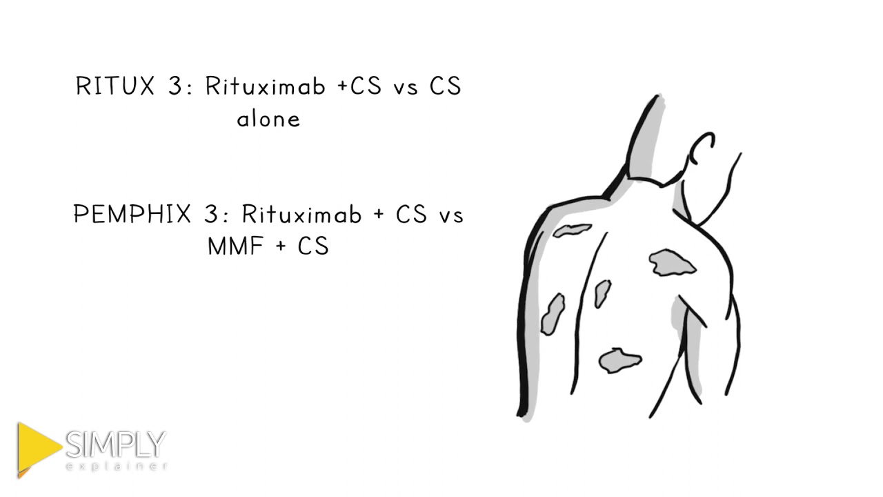 Strategies For Pemphigus Vulgaris Management | Paradigm Medical Communication