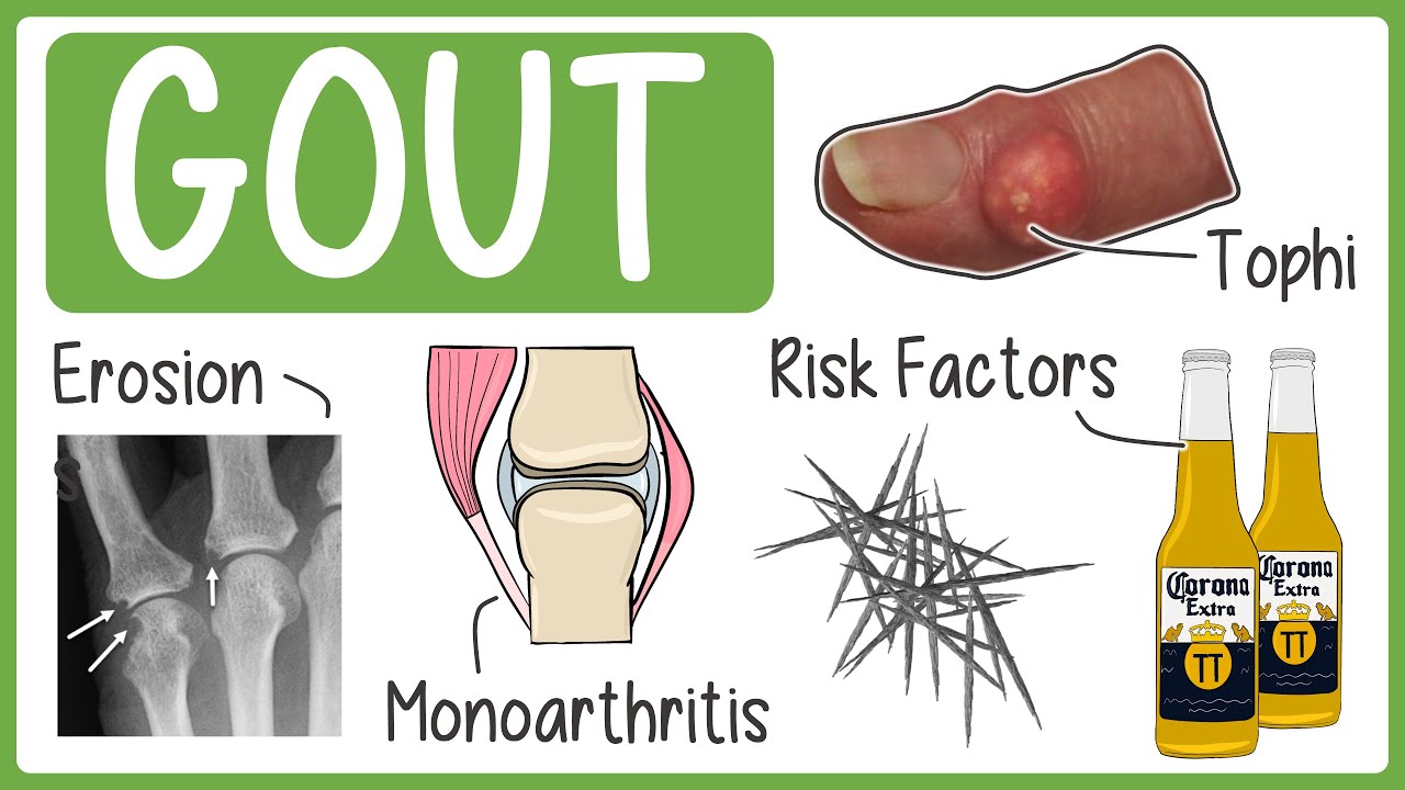 Gout in 3 minutes