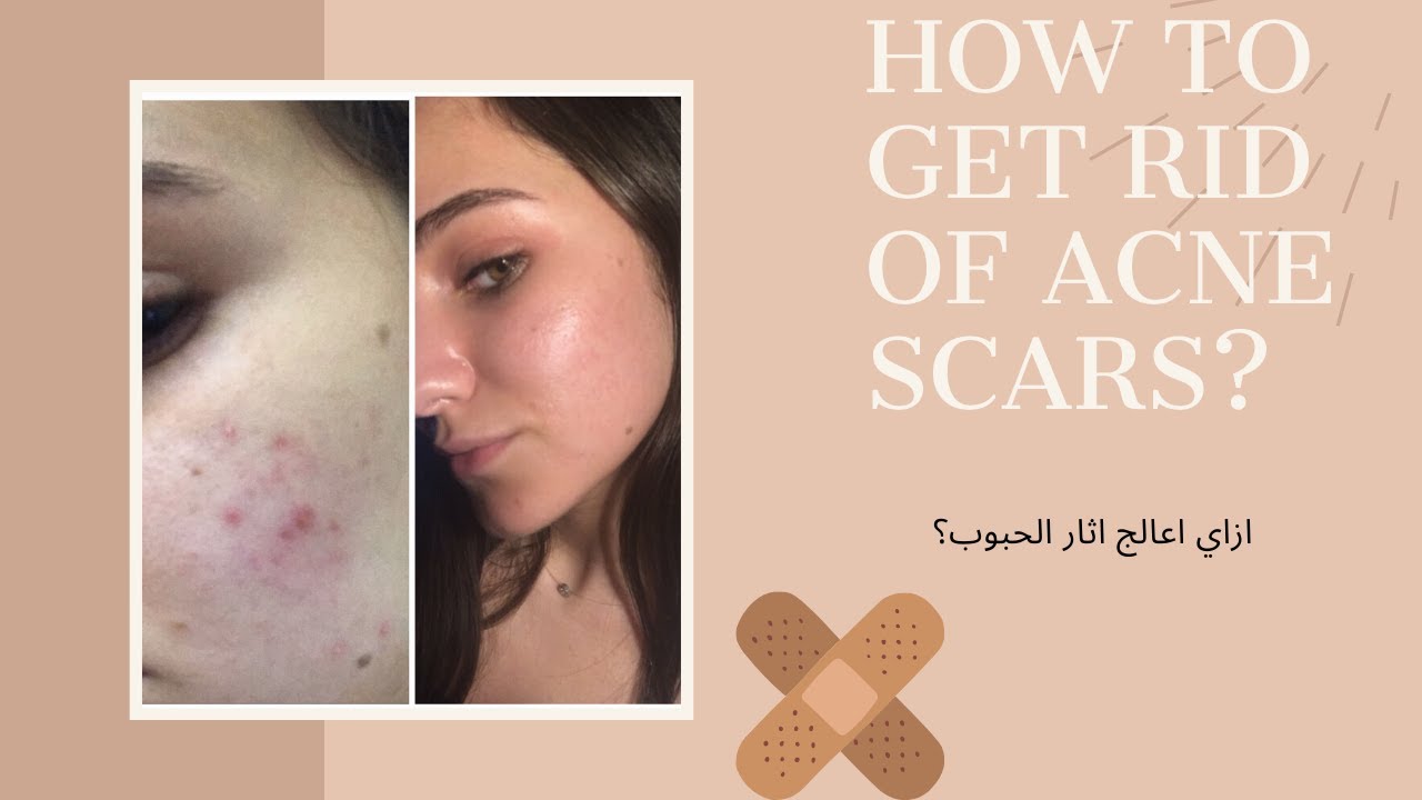 How to get rid of Acne Scars?- ازاي اعالج اثار الحبوب؟
