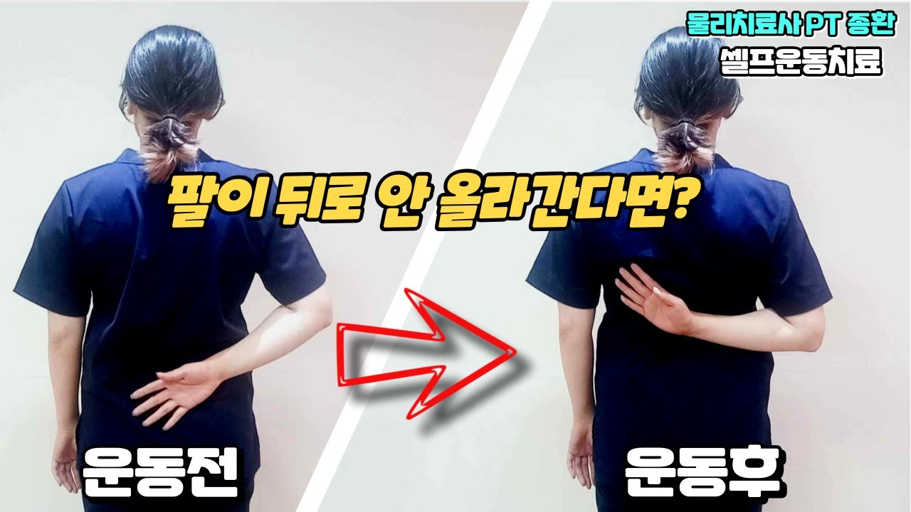 팔이 뒤로 안올라갈때 어깨 앞쪽 통증없이 어깨 내회전 제한을 해결해 주는 운동치료법#팔이뒤로안올라갈때#어깨내회전제한#어깨앞쪽통증