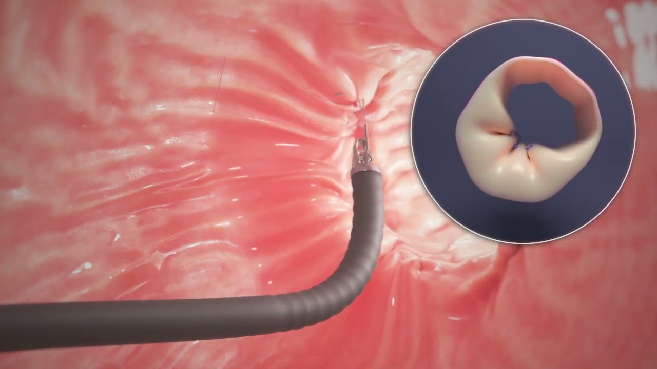 Endoscopic Sleeve Gastroplasty (ESG) Procedure Animation
