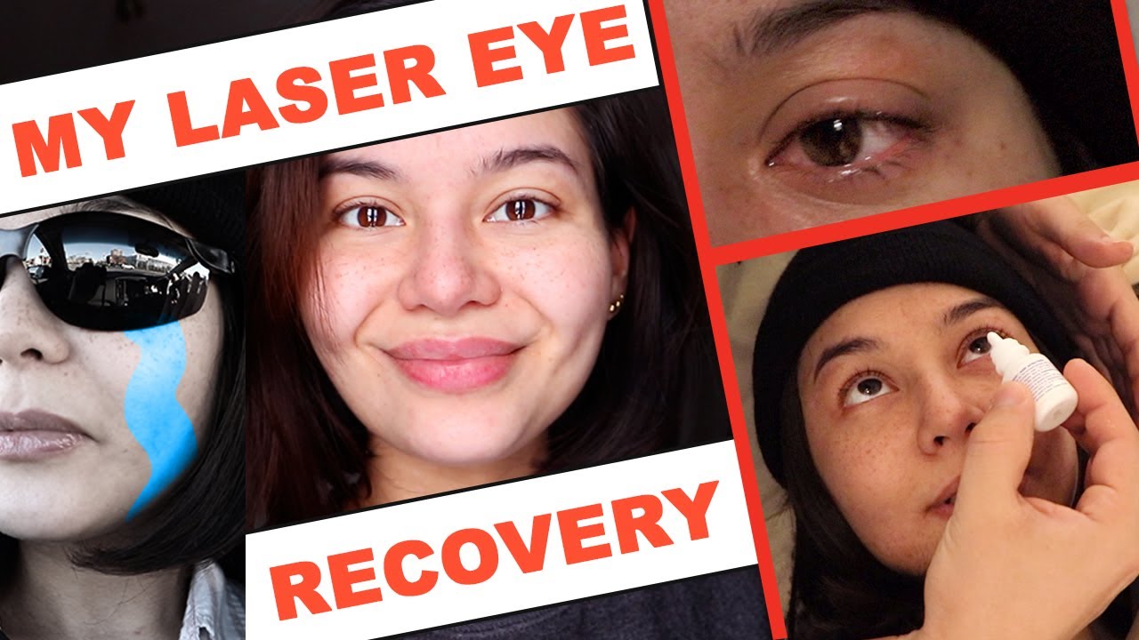 VLOG: PRK LASER EYE RECOVERY