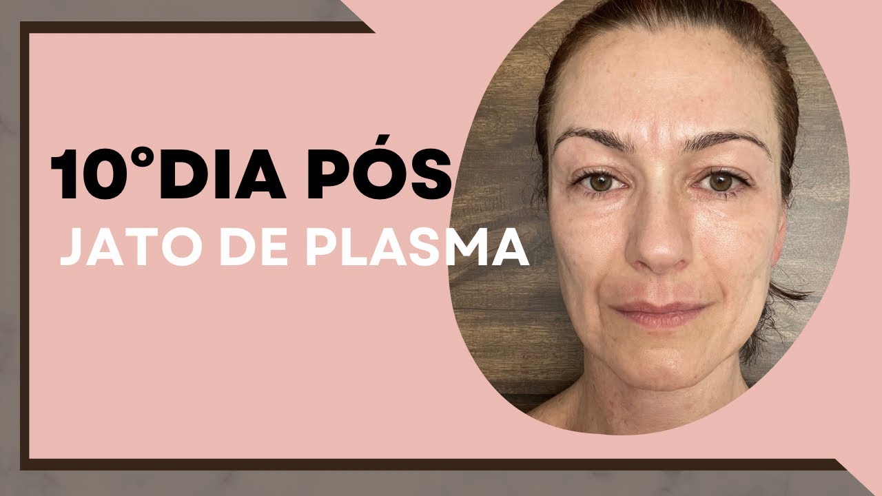 10° DIA PÓS JATO DE PLASMA @GiselePizzatoEsteticista