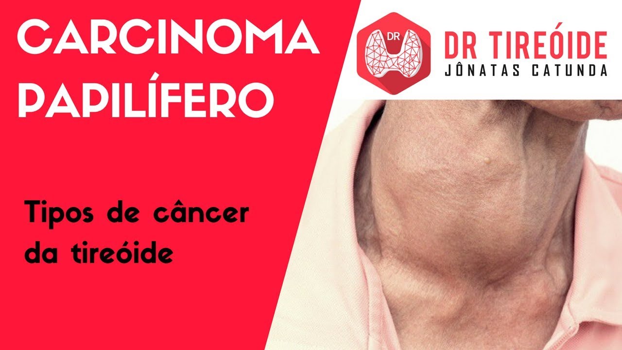 Carcinoma papilífero - Tipos de câncer de tireóide | Dr Jônatas Catunda