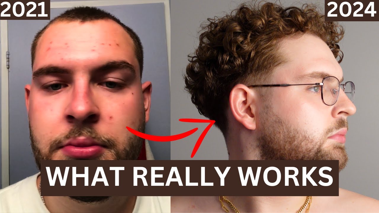 How I Cleared Up My Skin | How To Achieve Clear Skin Men | Mens Skin Care Tips