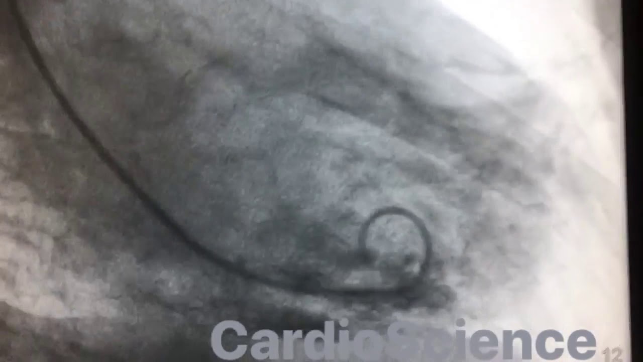 ECG  Infarto al miocardio inferior y lateral trombolizado