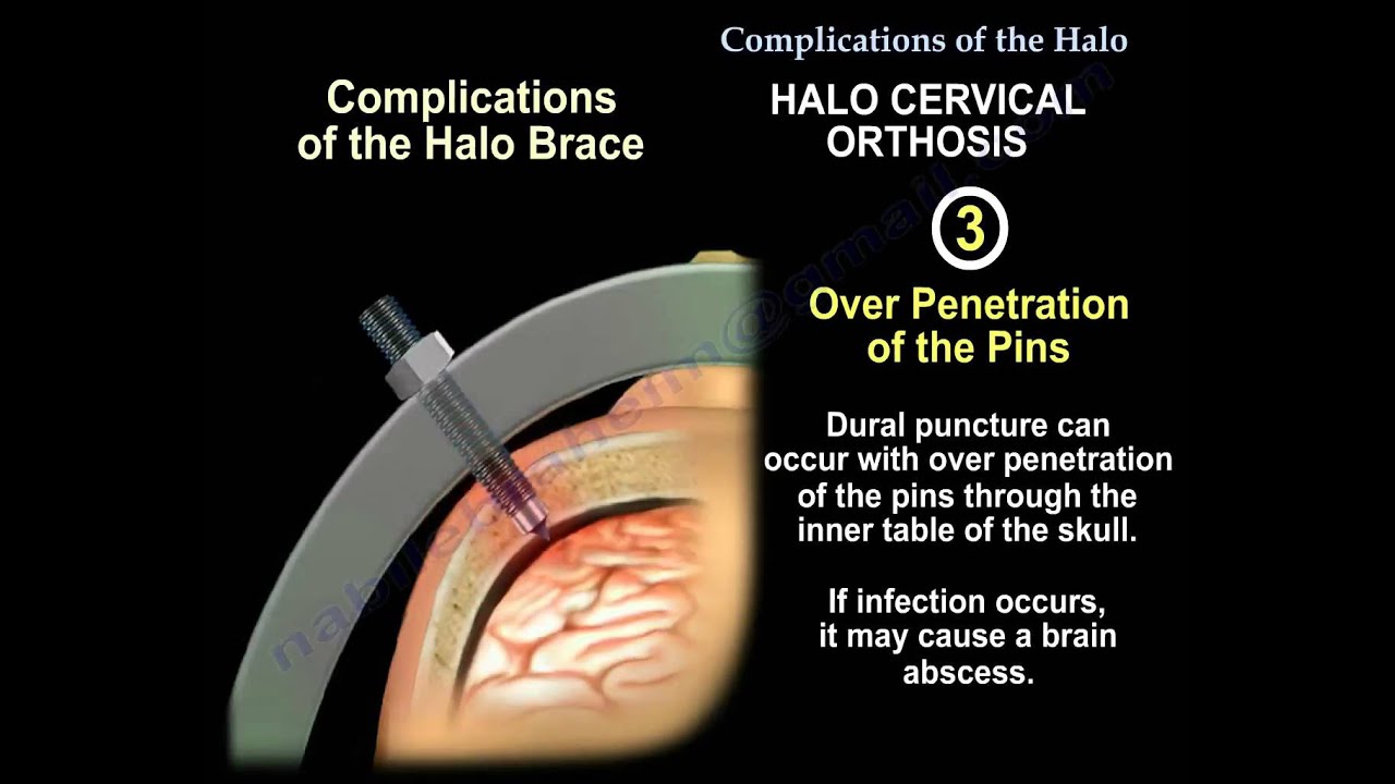 Complications Of The Halo - Everything You Need To Know - Dr. Nabil Ebraheim