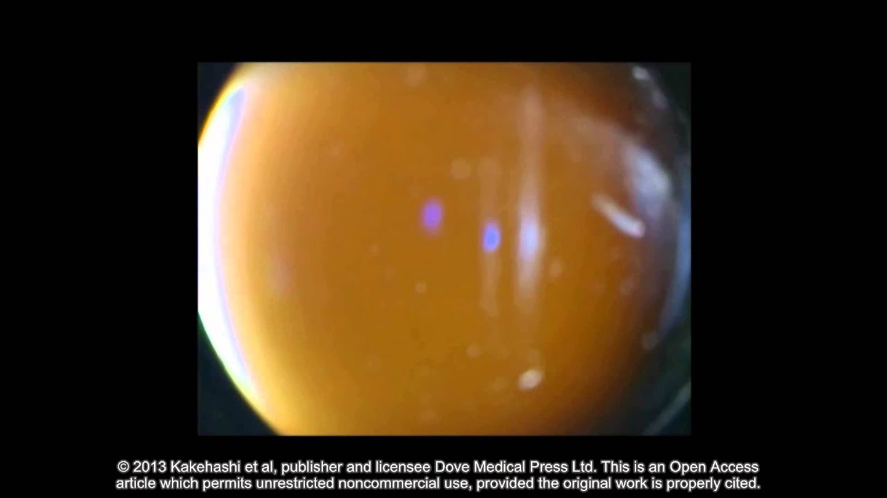 Classification of posterior vitreous detachment ID 54021 Supplementary video 4