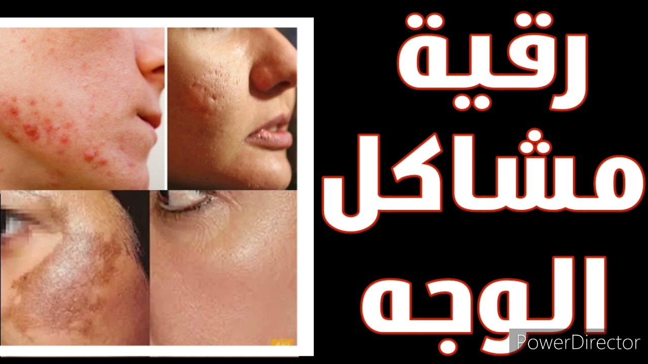 رقية حل لمشاكل الوجه إثر العين والحسد والسحر  (بقع داكنة،حب الشباب،حمرة،حساسية،شحوبة،حساسية....)