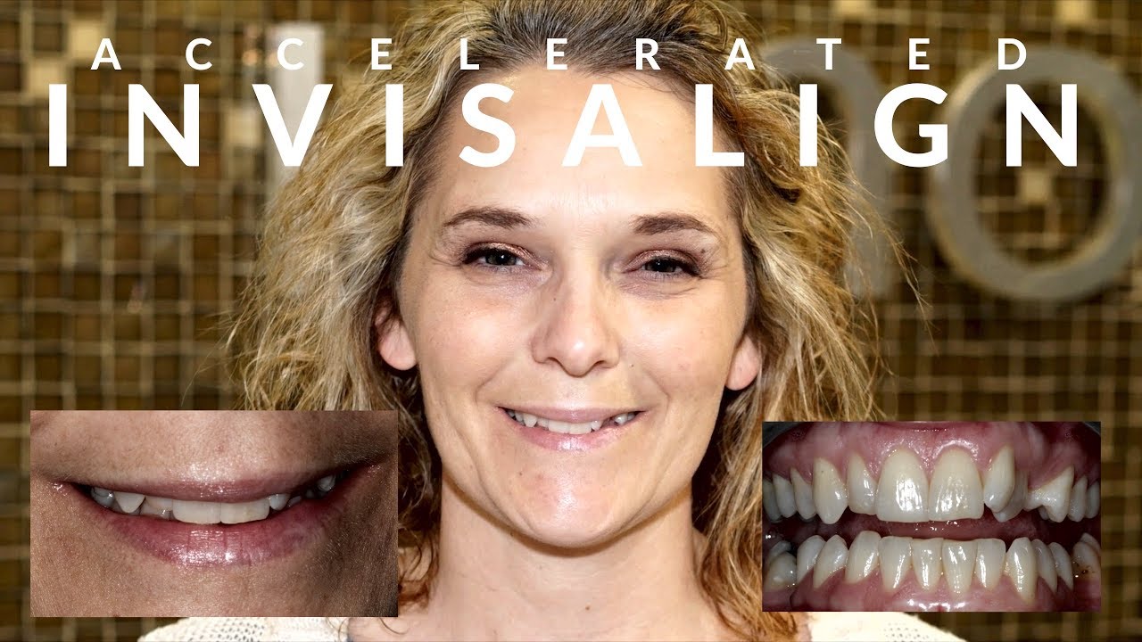 INVISALIGN Cross-bite - AMAZING Accelerated Smile Makeover in 7 MONTHS - EP 04