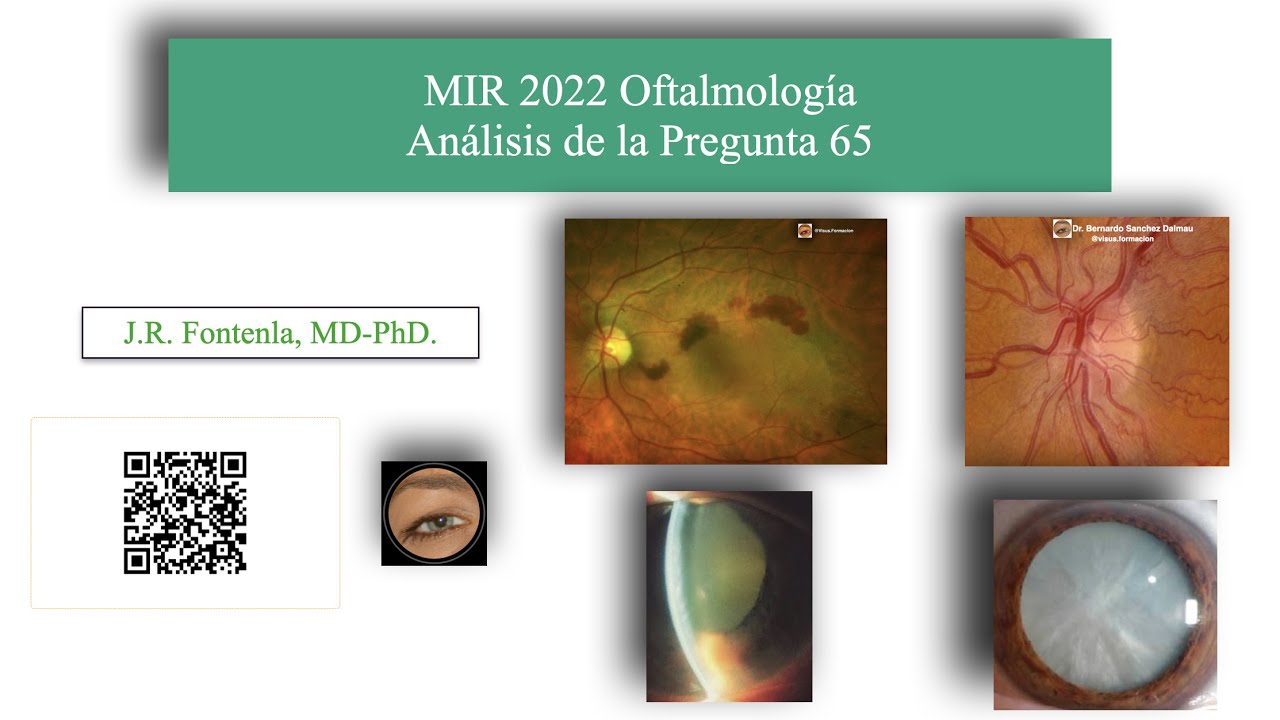 Examen MIR 2022. Oftalmología, Análisis de la Pregunta 65.