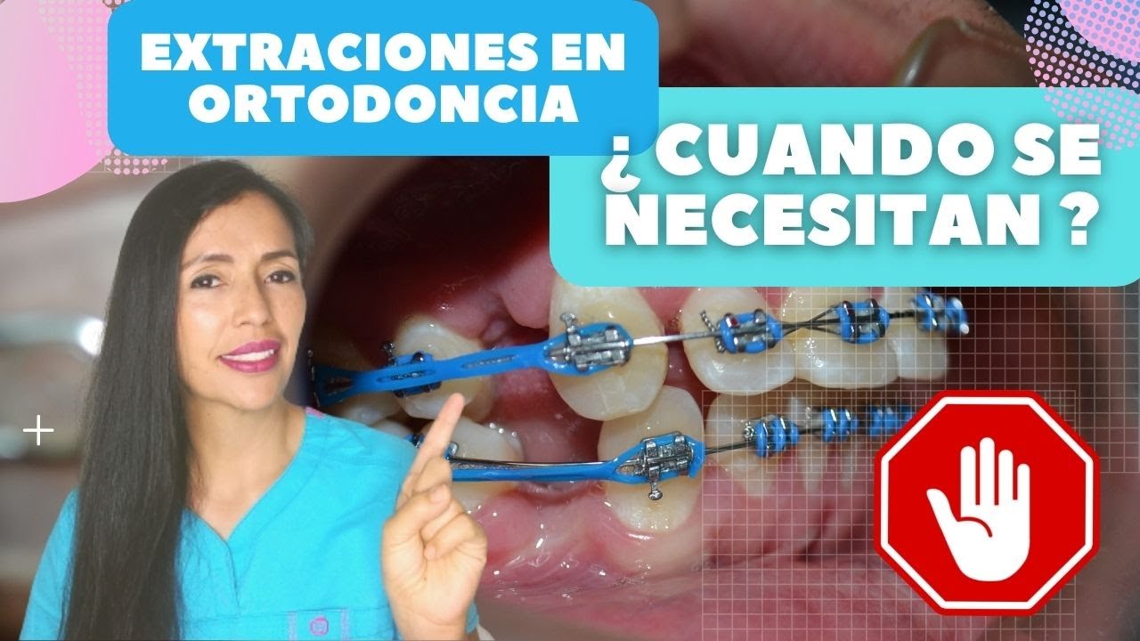 Extraciones en ortodoncia(brackets).  7 Razones para hacerlas
