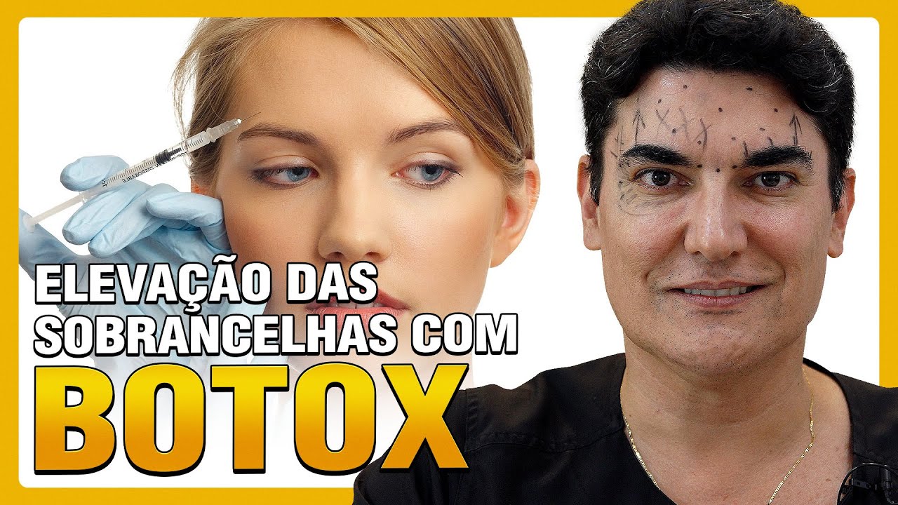 Elevação das Sobrancelhas com BOTOX