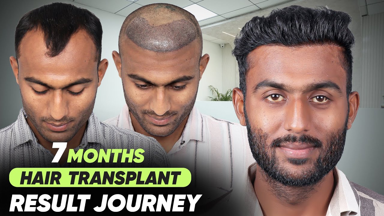 Hair Transplant in Patna  | Best Results & Cost of Hair Transplant in Patna