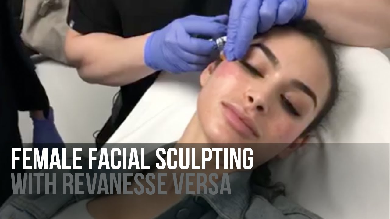 Live Female Facial Sculpting with Revanesse Versa Filler by Dr. Jason Emer | Before & After Result