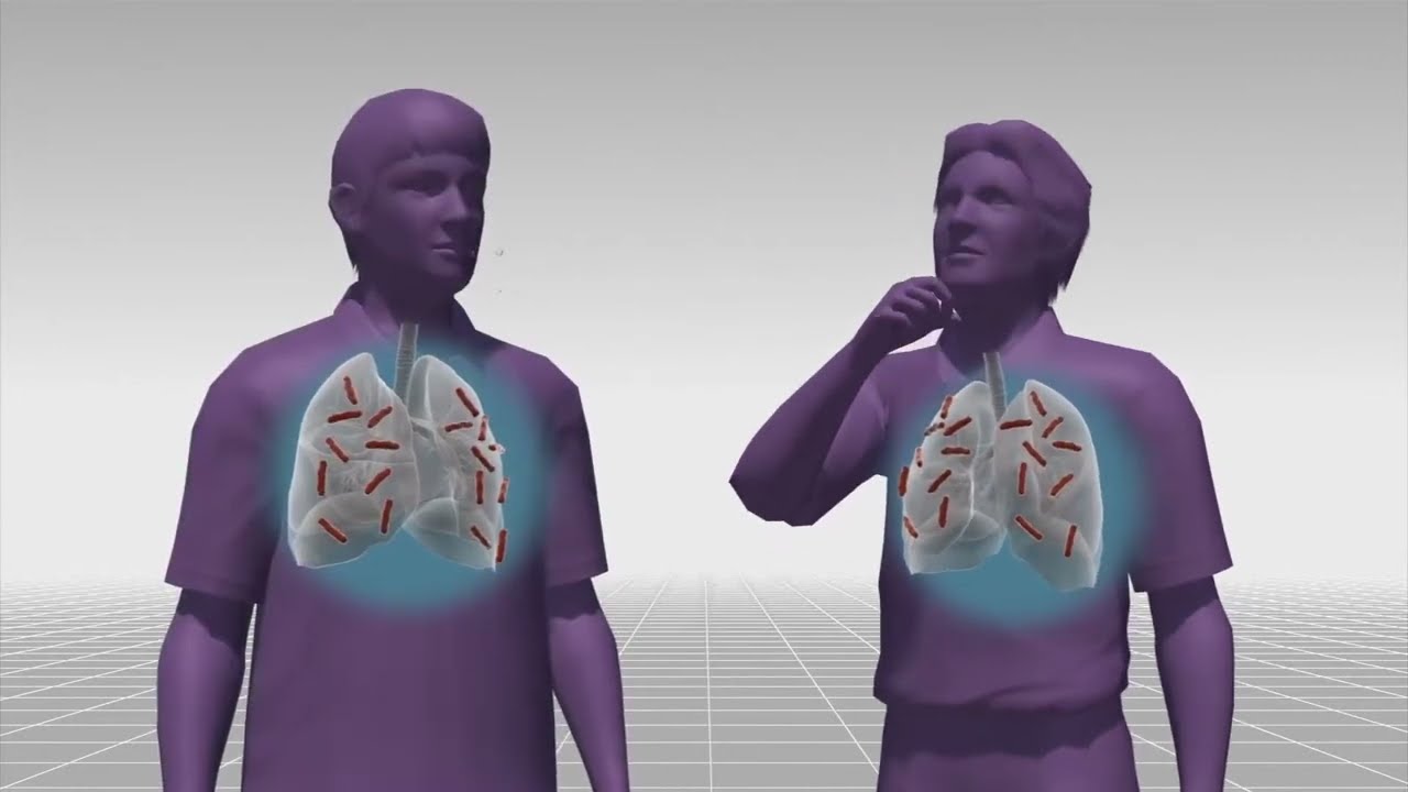 U phổi lành tính (phần 2)