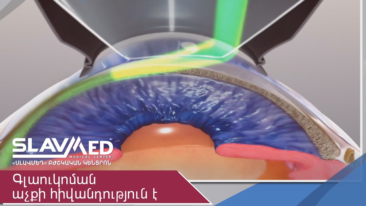 Գլաուկոման աչքի հիվանդություն է