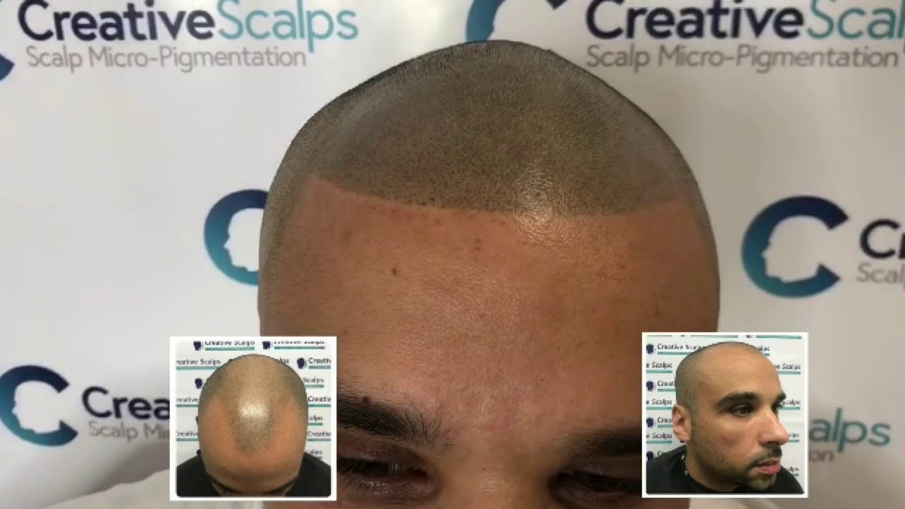 Hair Tattoo Scalp Micro Pigmentation SMP transformations @ Creative Scalps just like Fousey