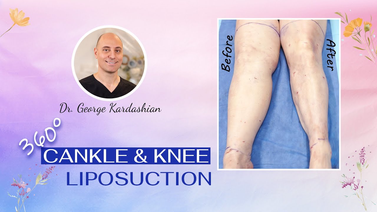 Shocking Leg Transformation: 360&deg; Cankle & Knee Liposuction Reveals Her Kneecap Again! 💥LIVE SURGERY