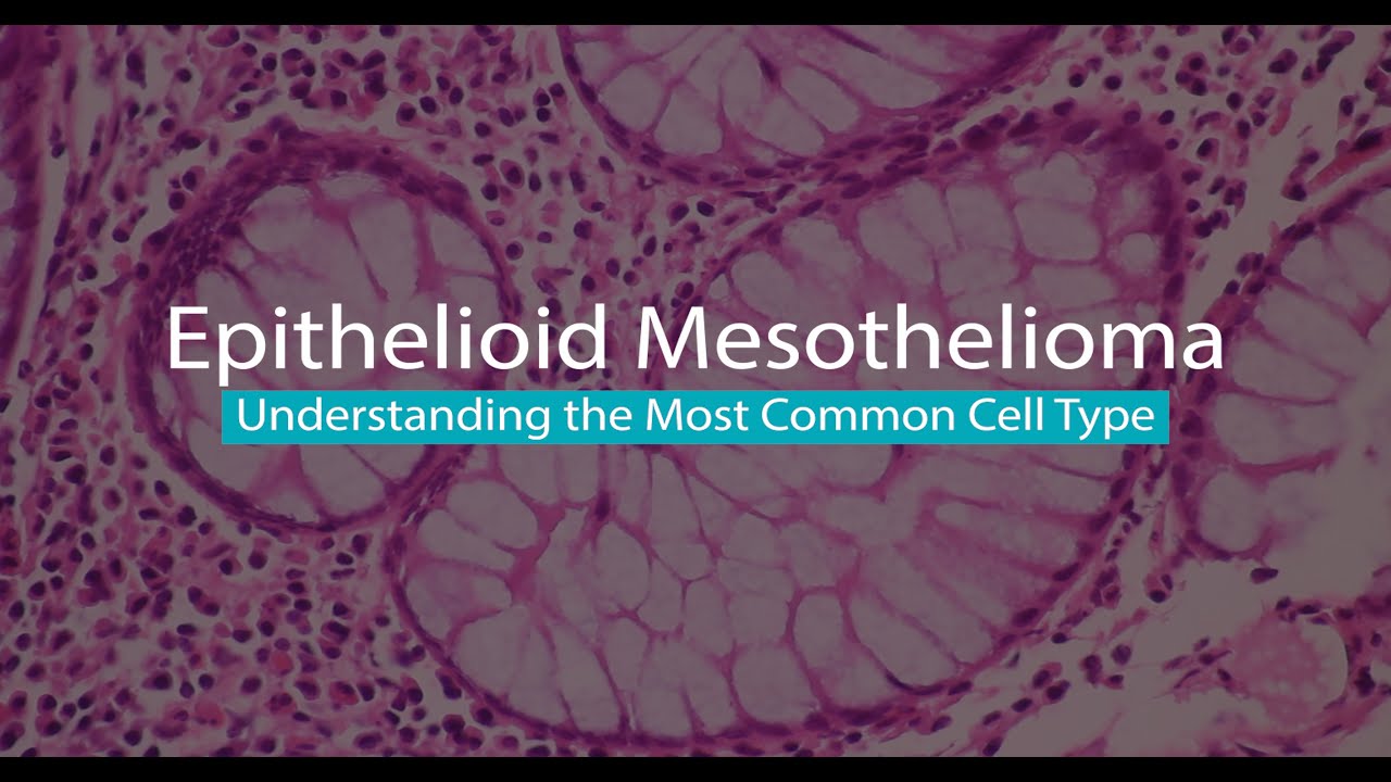 Epithelioid Mesothelioma | Mesothelioma Hope