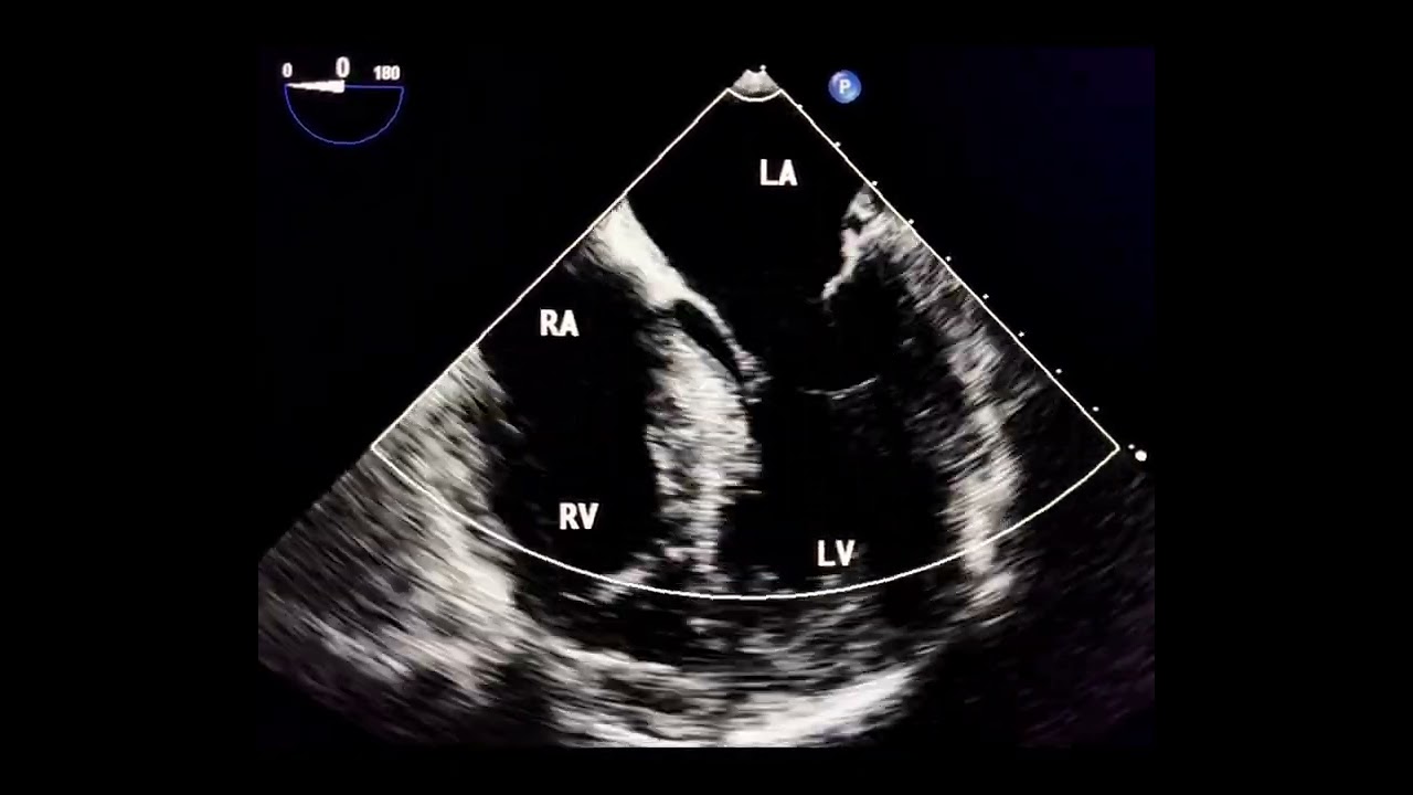 Systolic Anterior Motion of the Mitral Valve: A Critical But Overlooked Cause of Cardiac Syncope