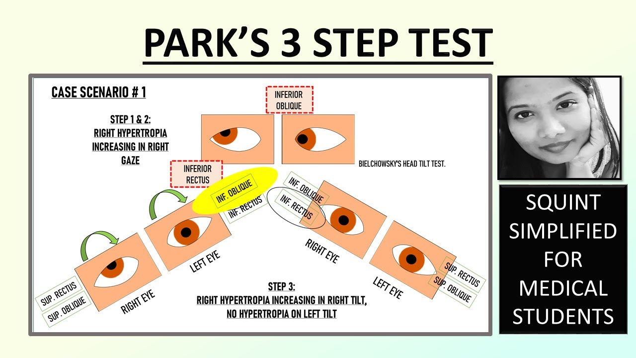 Park's 3 Step Test | Detailed Explanation + Easy Shortcut For Exams | Squint