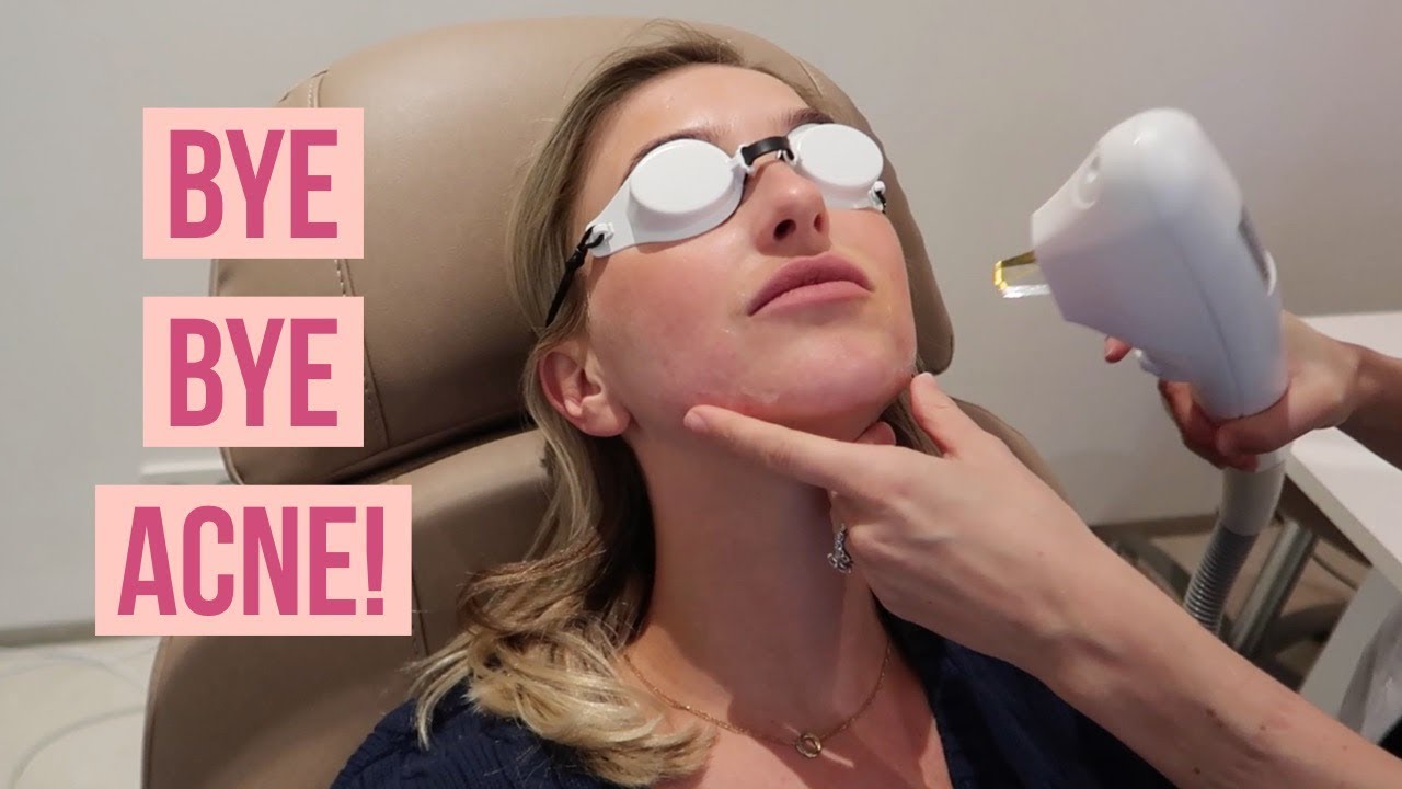 ACNE LITTEKENS WEGLASEREN | TIGERVITA #35