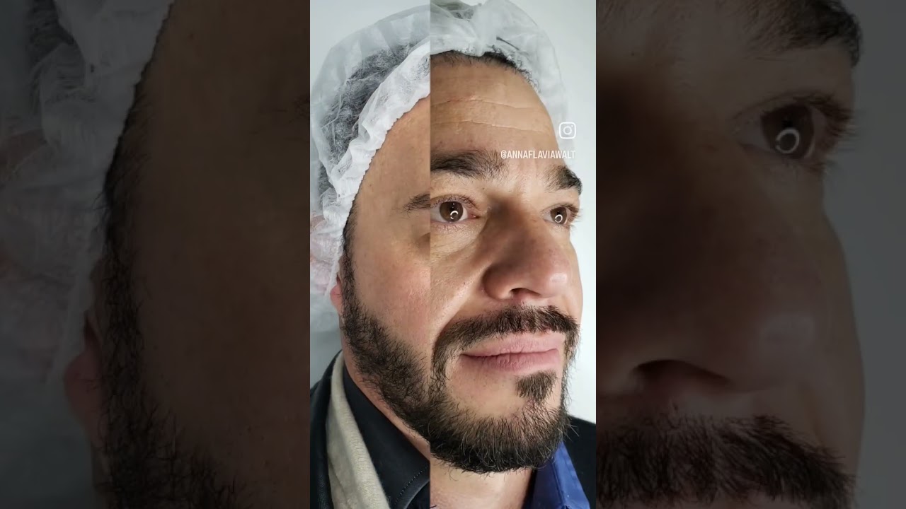 Olheiras ok ✔️                               Bigode chin&ecirc;s ✔️ Botox✔️