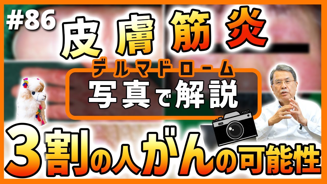 第86話 【皮膚は内臓の鏡③】皮膚筋炎を写真で解説！3割の人ががんの可能性が！？