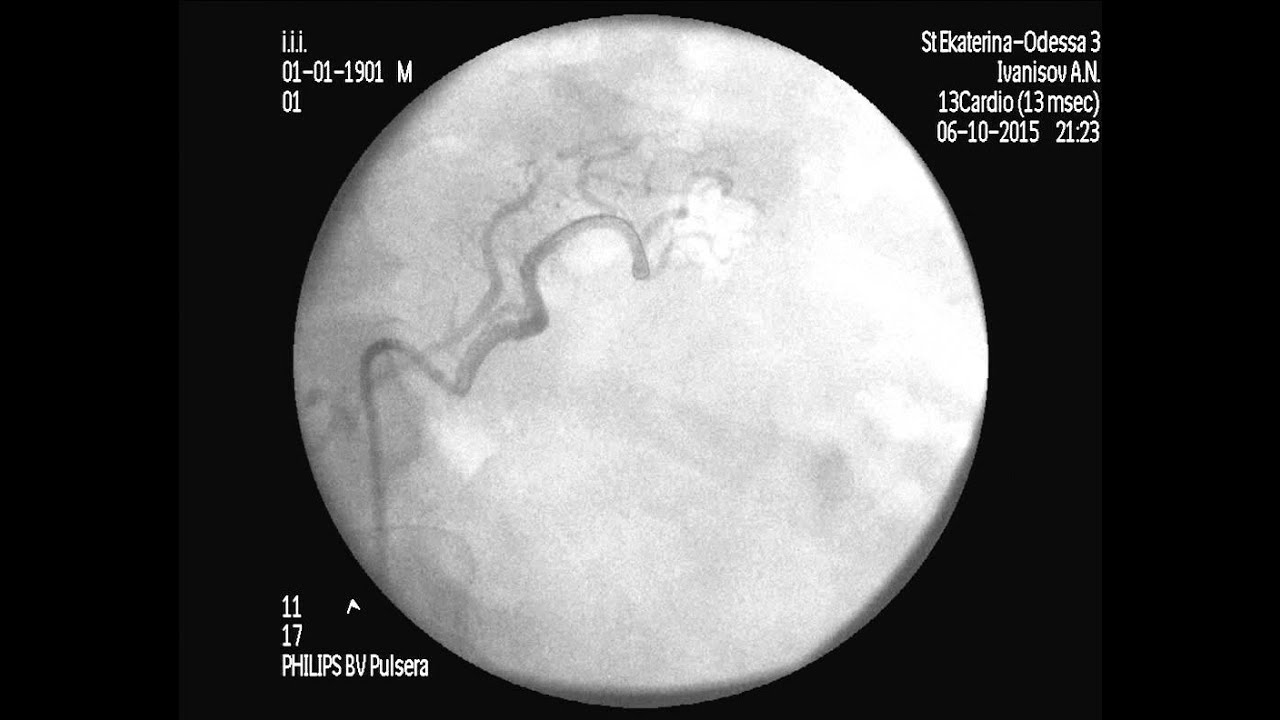 left gastric artery
