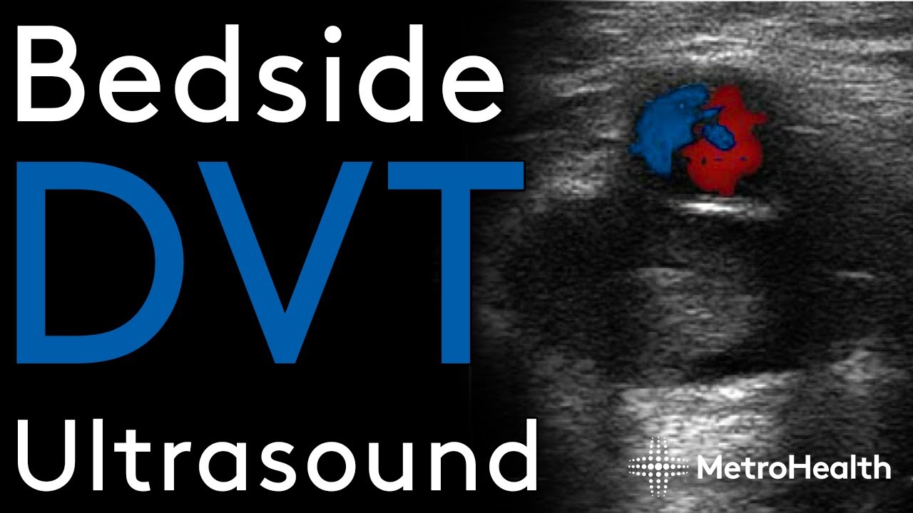 Bedside DVT Ultrasound