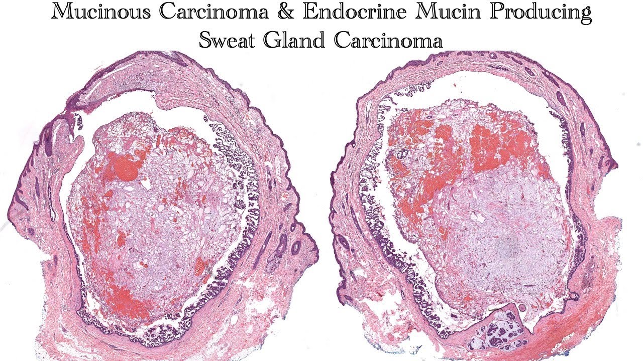 Mucinous carcinoma & endocrine mucin-producing sweat gland carcinoma (AIP France 2021 - Case 5)