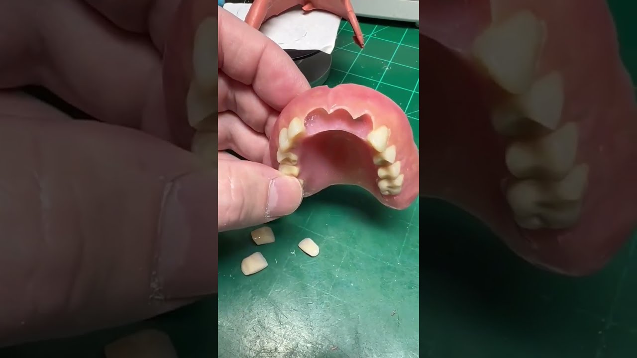 Denture add pontics