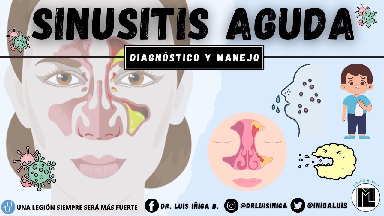 Sinusitis aguda | Etiología, Patogenia, Clínica, Diagnóstico y Tratamiento