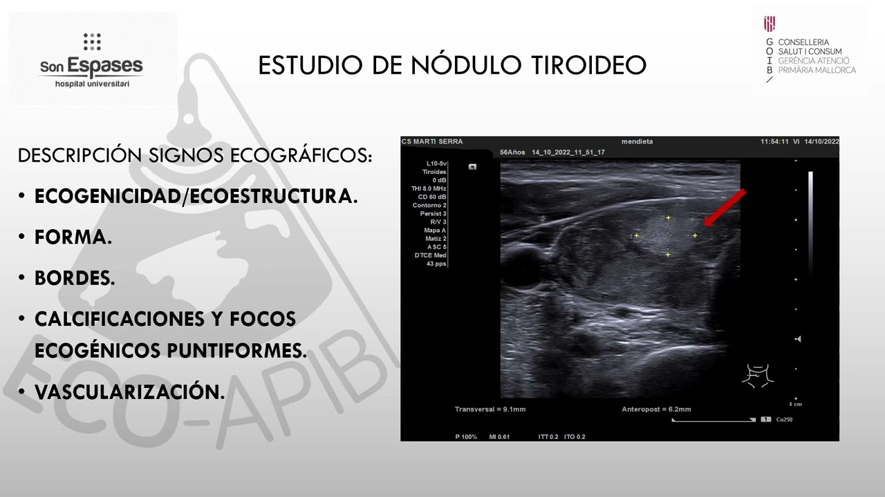 ECOGRAFÍA DE TIROIDES PARTE II :ECOGRAFIA DEL NODULO TIROIDEO Y ADENOPATIAS. Dr.Argüelles.Endocrino