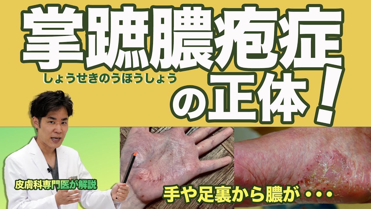 掌蹠膿疱症（しょうせきのうほうしょう）の正体！手の平や足の裏から膿が・・・