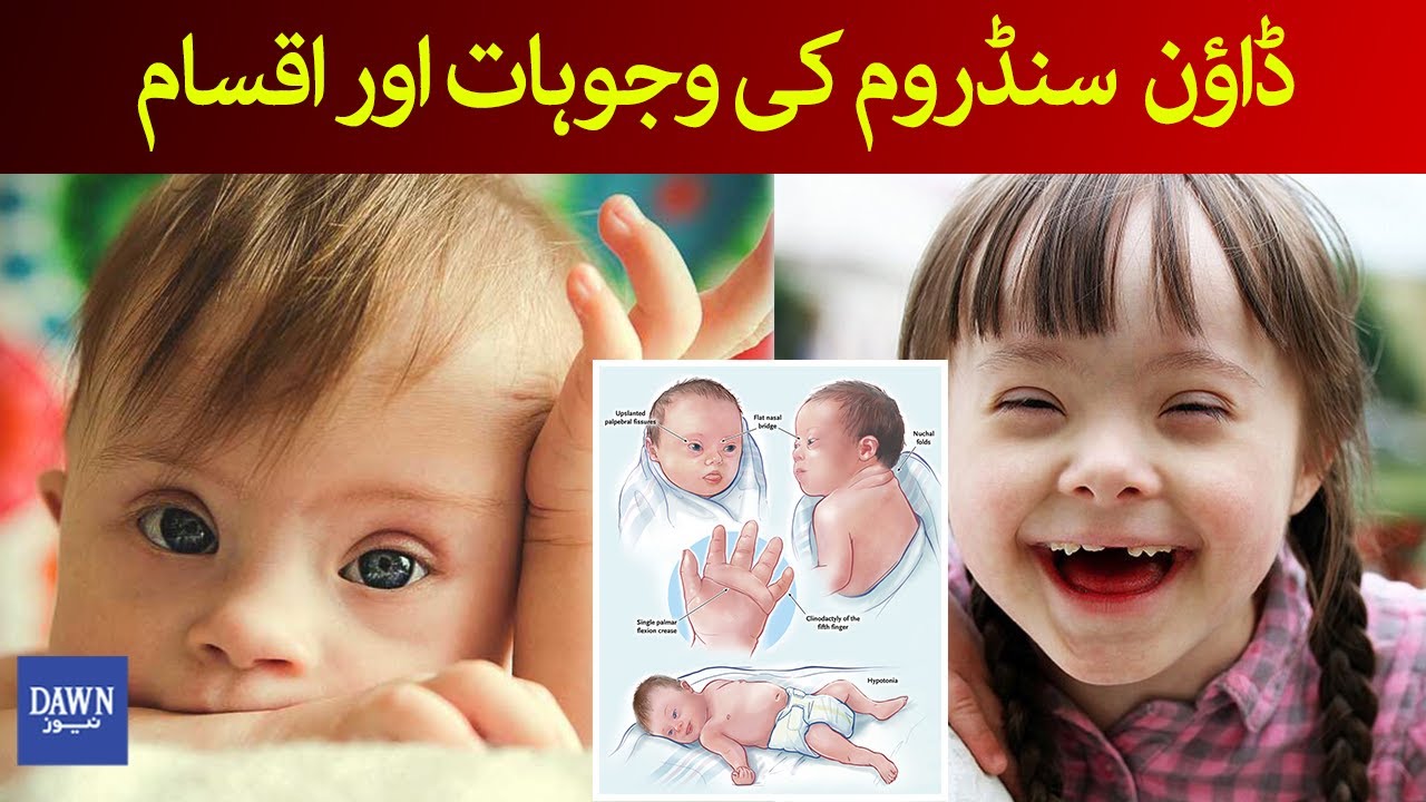 Health First | Understanding Downs Syndrome | Dawn News