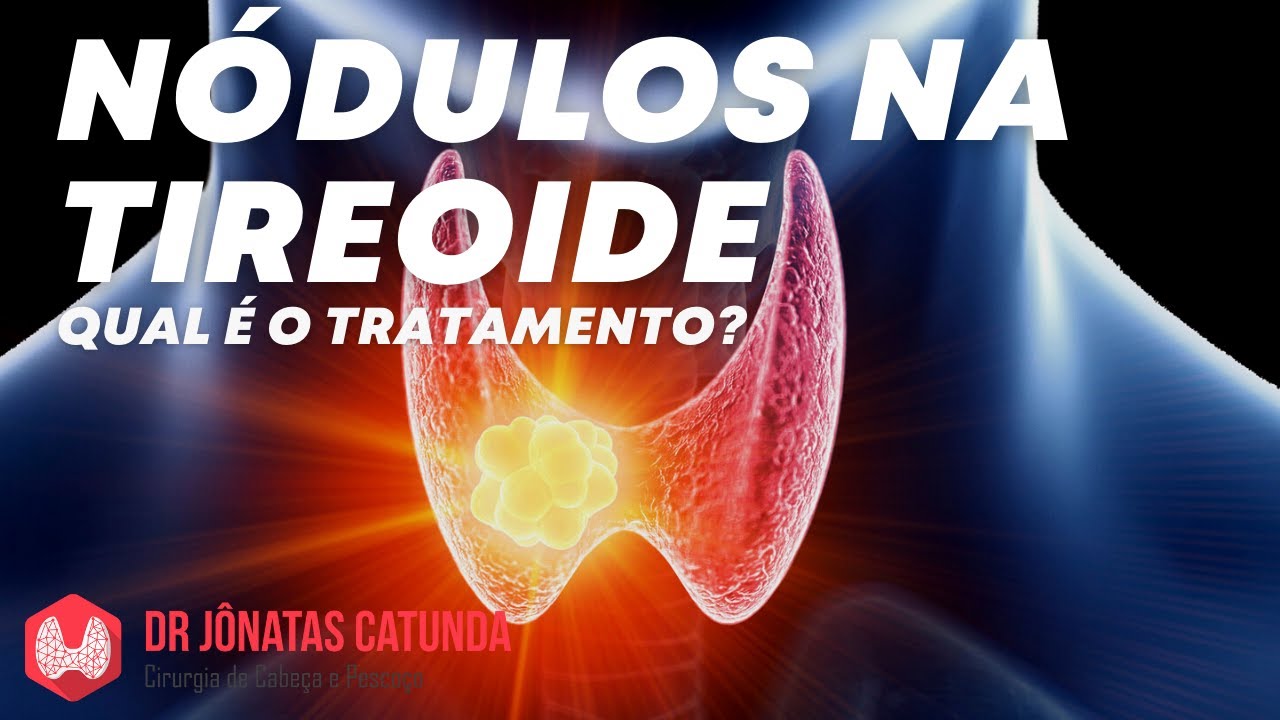 N&oacute;dulo na tireoide: existe medicamento para fazer o n&oacute;dulo regredir?